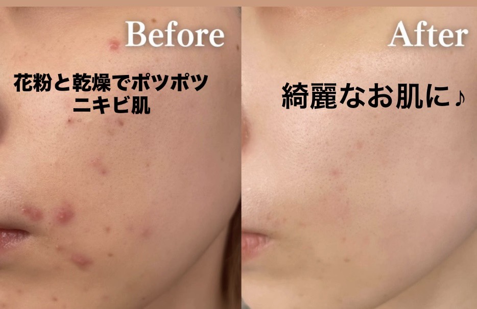 花粉・乾燥によるニキビ肌 Before & After