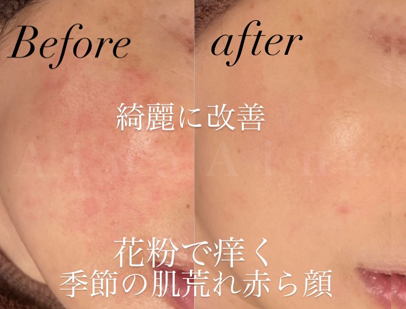 花粉・季節の肌荒れ赤ら顔 Before & After