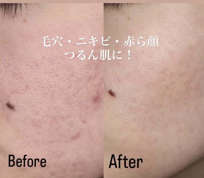 毛穴・ニキビ・赤ら顔 Before & After