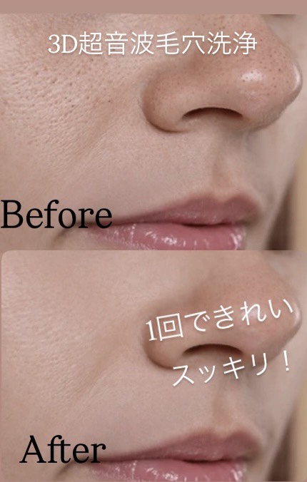 3D超音波毛穴洗浄 Before & After
